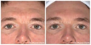 Botox Before and After Photo 11 at Cerulean Medical Institute in Kelowna BC