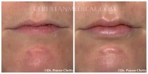 Lip Enhancement Before and After Photo 7 at Cerulean Medical Institute in Kelowna BC