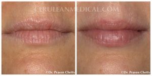 Lip Enhancement Before and After Photo 8 at Cerulean Medical Institute in Kelowna BC