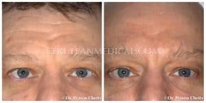 Skin Tightening Before and After Photo 9 at Cerulean Medical Institute in Kelowna BC