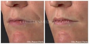 Smile Lines or Nasolabial Fold Fillers Before and After Photo at Cerulean Medical Institute in Kelowna BC