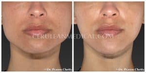 Jawline slimming with Jaw Botox or Botox Masseter Before and After Photo 1