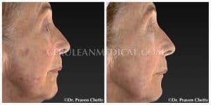 Chemical Peel Before and After Photo 5 at Cerulean Medical Institute in Kelowna BC
