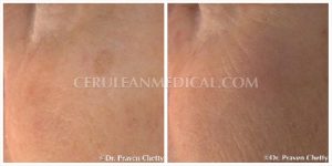 Chemical Peel Before and After Photo 6 at Cerulean Medical Institute in Kelowna BC