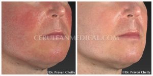 Rosacea Treatment Before and After Photo 5 at Cerulean Medical Institute in Kelowna BC