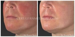 Rosacea Treatment Before and After Photo 6 at cerulean Medical Institute in Kelowna BC