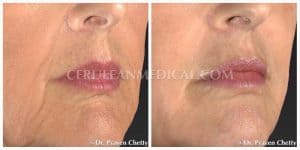 Smile Lines or Nasolabial Fold Fillers Before and After Photo 1 at Cerulean Medical Institute in Kelowna BC