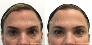 Temple and Cheek dermal filler before and after