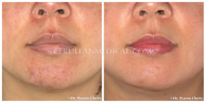 Maskne before and after photo at Cerulean Medical Institute in Kelowna BC