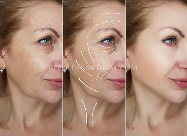 non surgical facelift before and after at Cerulean Medical Institute in Kelowna BC