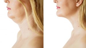 agion neck treatment before and after