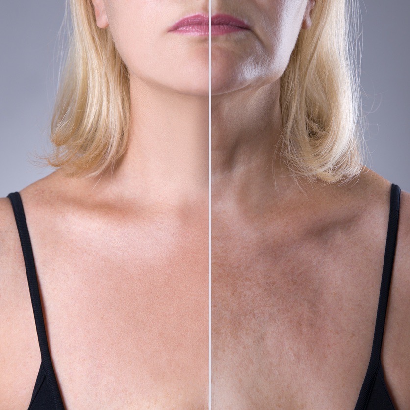 Treatment options for the Décolletage, Kelowna, British Columbia, Anti-Aging, Younger Looking, IPL Photorejuvenation, Microneedling, Botox, dermal fillers, peels, lasers, Skin Care, Sun Protection