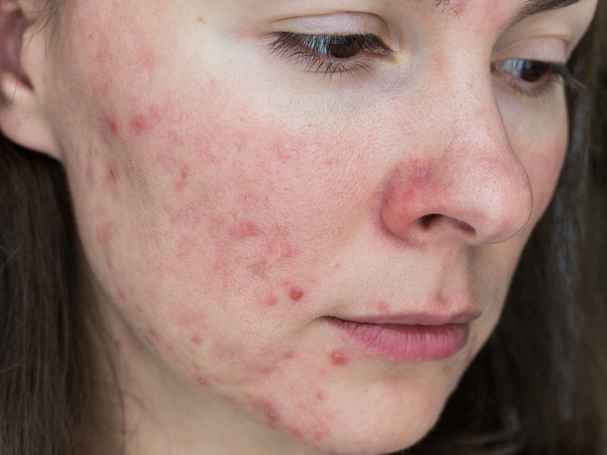 Everything You Want to Know About Rosacea at Cerulean Medical Institute in Kelowna BC