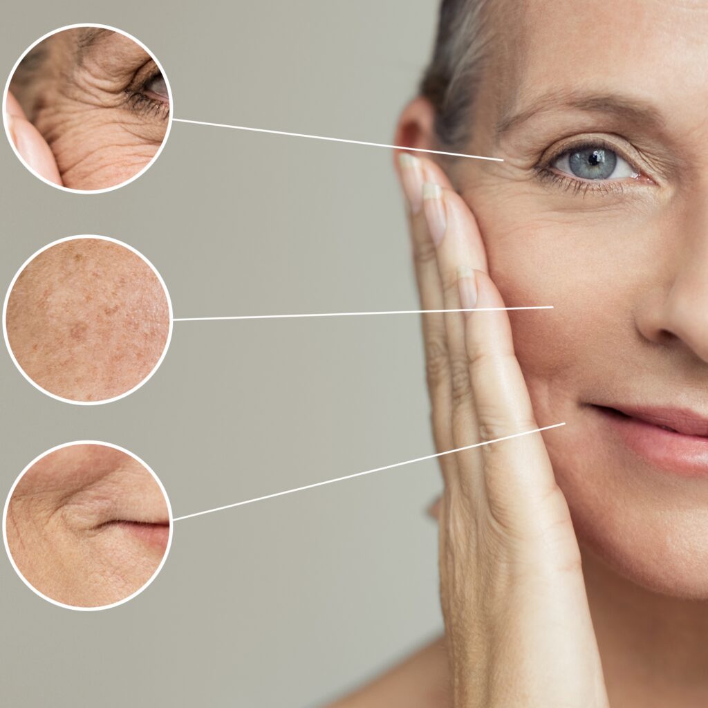 Botox for Improved Skin Tone and Texture at Cerulean Medical Institute in Kelowna BC