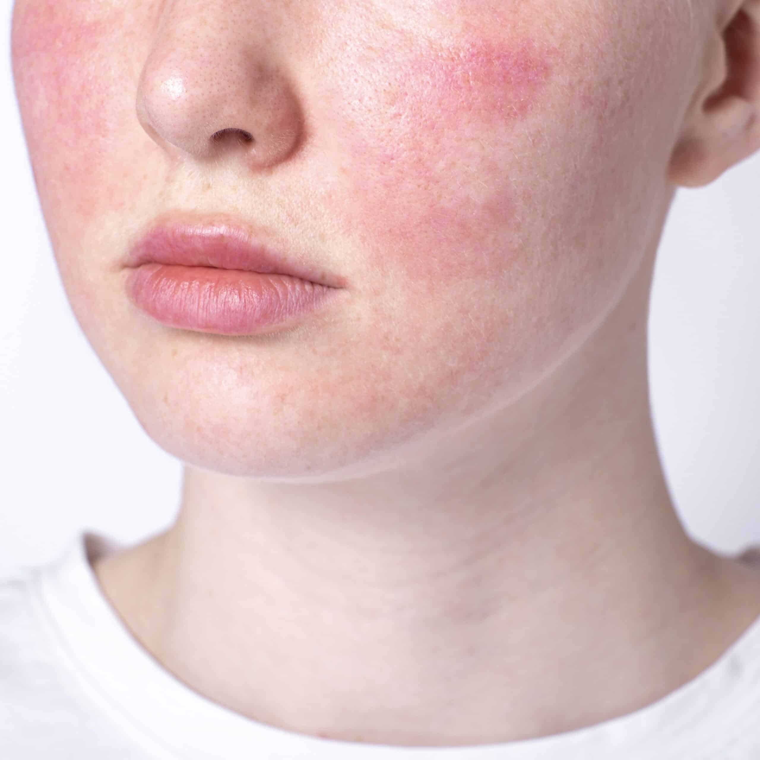 Laser Treatment Benefits for Rosacea at Cerulean Medical Institute in Kelowna BC