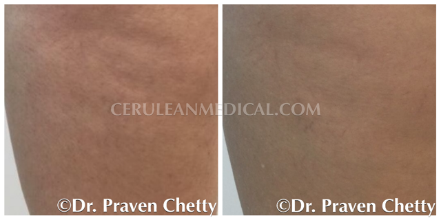 Radiesse Before and After Photo 4 at Cerulean Medical Institute in Kelowna BC