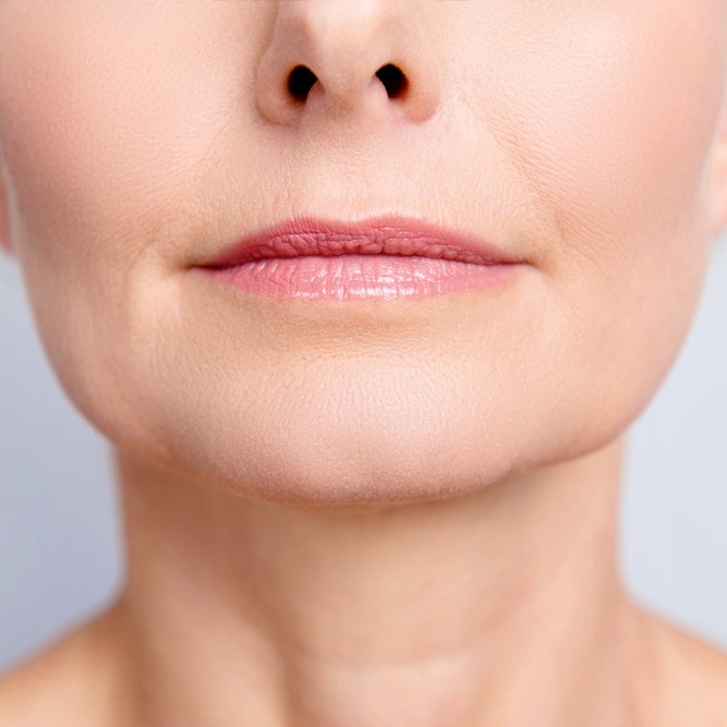 Best Lip Wrinkle Treatment Options at Cerulean Medical Institute in Kelowna BC
